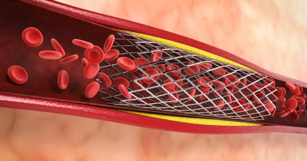 Coronary Angioplasty and Stenting