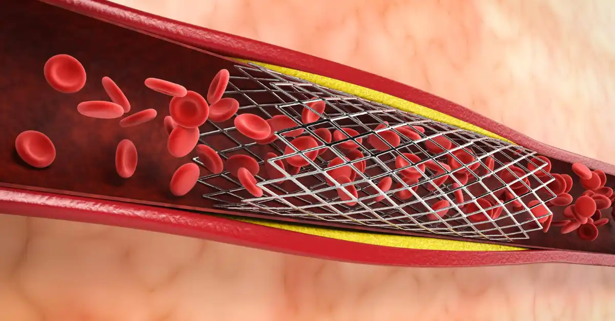 Coronary Angioplasty and Stenting